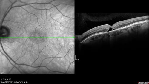 Macular Telangiectasia - Stage 5 left eye - 20/40 vision after 2 years of Avastin 
Spectral Domain OCT Line Scan
