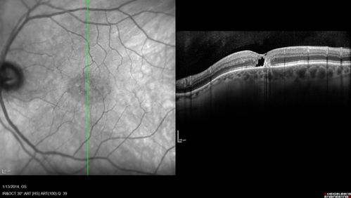 Macular Telangiectasia - Stage 5 left eye - 20/40 vision after 2 years of Avastin 
Spectral Domain OCT Line Scan
