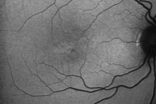 Macular Telangiectasis (Group 2a Juxtafoveal Telangiectasis) Decreased Fundus Autofluorescence
63-year-old woman has juxtafoveal retinal telangiectasis in both eyes.  She notices her vision a little worse with more distortion and change over the last six months.  

VISUAL ACUITY:  OD 20/40,  OS 20/40.
