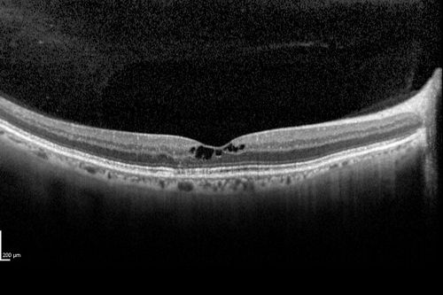Macular Telangiectasis (Group 2a Juxtafoveal Telangiectasis) Decreased Fundus Autofluorescence
63-year-old woman has juxtafoveal retinal telangiectasis in both eyes.  She notices her vision a little worse with more distortion and change over the last six months.  

VISUAL ACUITY:  OD 20/40,  OS 20/40.

