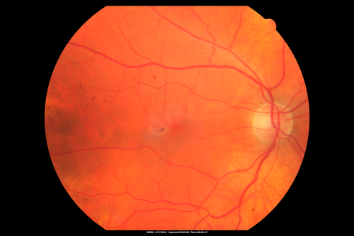 Macular Telangiectasis - visible telangiectasia on color photos
Multicolor photos too show pathology.  This patient had 20/50 vision with pinhole to 20/25
