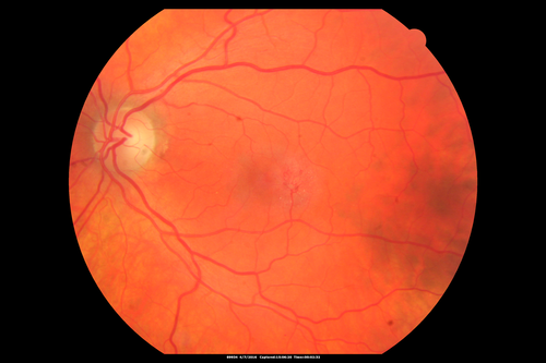 Macular Telangiectasis - visible telangiectasia on color photos
Multicolor photos too show pathology.  This patient had 20/50 vision with pinhole to 20/25
