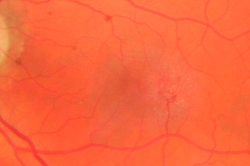 Macular Telangiectasis - visible telangiectasia on color photos
Multicolor photos too show pathology.  This patient had 20/50 vision with pinhole to 20/25
