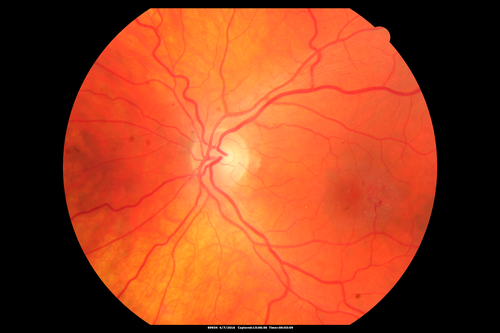 Macular Telangiectasis - visible telangiectasia on color photos
Multicolor photos too show pathology.  This patient had 20/50 vision with pinhole to 20/25
