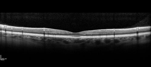 Macular Telangiectasis - visible telangiectasia on color photos
Multicolor photos too show pathology.  This patient had 20/50 vision with pinhole to 20/25
