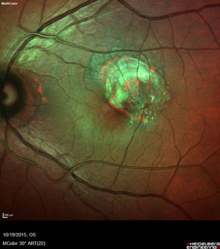 Macular Telangiectasi - Stage V - CNVM OU
60 year old female who has been treated with injections for 5 years starting in the left eye.  She had no treatment 6 months prior to this visit and her vision has been getting worse.  Her vision is 20/100 OD, 20/32 OS.  Vision improved with intravitreal Avastin to 20/30 OU.
