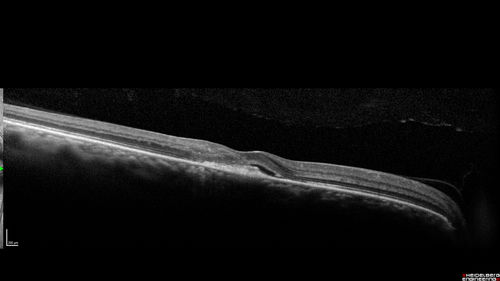 Macular Telangiectasi - Stage V - CNVM OU
60 year old female who has been treated with injections for 5 years starting in the left eye.  She had no treatment 6 months prior to this visit and her vision has been getting worse.  Her vision is 20/100 OD, 20/32 OS.  Vision improved with intravitreal Avastin to 20/30 OU.
