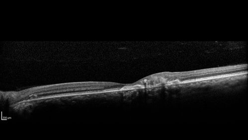 Macular Telangiectasi - Stage V - CNVM OU
60 year old female who has been treated with injections for 5 years starting in the left eye.  She had no treatment 6 months prior to this visit and her vision has been getting worse.  Her vision is 20/100 OD, 20/32 OS.  Vision improved with intravitreal Avastin to 20/30 OU.
