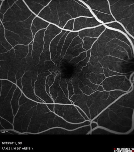 Macular Telangiectasi - Stage V - CNVM OU
60 year old female who has been treated with injections for 5 years starting in the left eye.  She had no treatment 6 months prior to this visit and her vision has been getting worse.  Her vision is 20/100 OD, 20/32 OS.  Vision improved with intravitreal Avastin to 20/30 OU.
