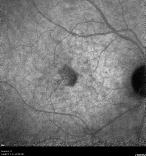 Macular Telangiectasi - Stage V - CNVM OU
60 year old female who has been treated with injections for 5 years starting in the left eye.  She had no treatment 6 months prior to this visit and her vision has been getting worse.  Her vision is 20/100 OD, 20/32 OS.  Vision improved with intravitreal Avastin to 20/30 OU.
