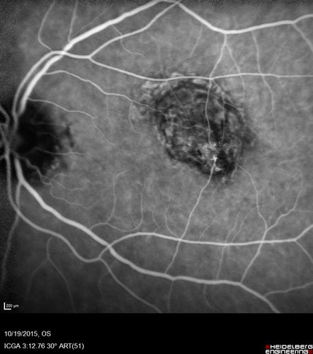 Macular Telangiectasi - Stage V - CNVM OU
60 year old female who has been treated with injections for 5 years starting in the left eye.  She had no treatment 6 months prior to this visit and her vision has been getting worse.  Her vision is 20/100 OD, 20/32 OS.  Vision improved with intravitreal Avastin to 20/30 OU.
