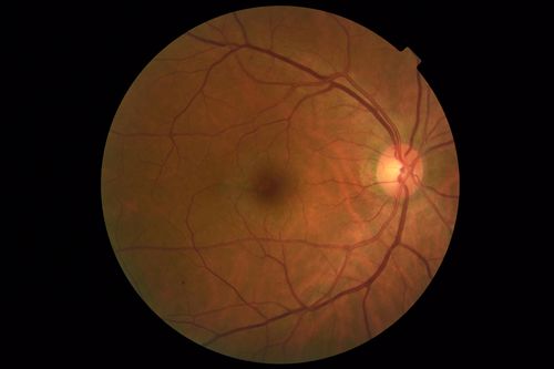 MacTel - Juxtafoveal Telangiectasis
56 year old man with a lot of difficulty adjusting to vision loss
