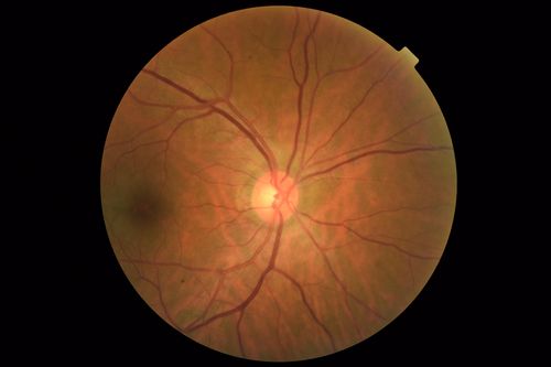 MacTel - Juxtafoveal Telangiectasis
56 year old man with a lot of difficulty adjusting to vision loss
