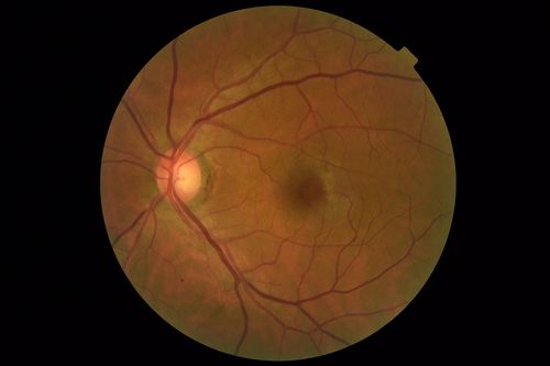 MacTel - Juxtafoveal Telangiectasis
56 year old man with a lot of difficulty adjusting to vision loss
