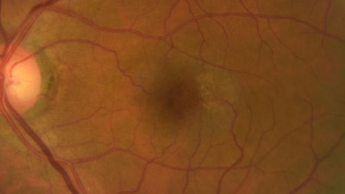 MacTel - Juxtafoveal Telangiectasis
56 year old man with a lot of difficulty adjusting to vision loss
