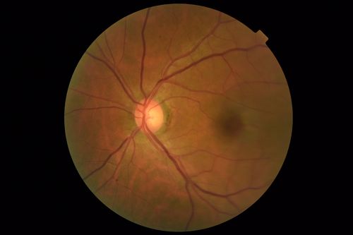 MacTel - Juxtafoveal Telangiectasis
56 year old man with a lot of difficulty adjusting to vision loss
