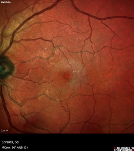 Macular Telangiectasis and Vision loss following vitrectomy with membrane peel
76 year old man with MacTel who had membrane peel in the right eye 10 years ago with permanent vision loss.  
VA OD: sc20/200-4 and VA OS: sc20/25-1

