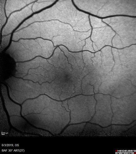 Macular Telangiectasis and Vision loss following vitrectomy with membrane peel
76 year old man with MacTel who had membrane peel in the right eye 10 years ago with permanent vision loss.  
VA OD: sc20/200-4 and VA OS: sc20/25-1
