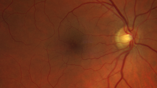 Macular Telangiectasia - Mild
56 year old female with good vision and mild macular telangiectasia.  VA 20/40 OD 20/16 OS
