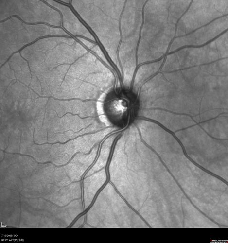 Macular Telangiectasia - Mild
56 year old female with good vision and mild macular telangiectasia.  VA 20/40 OD 20/16 OS
