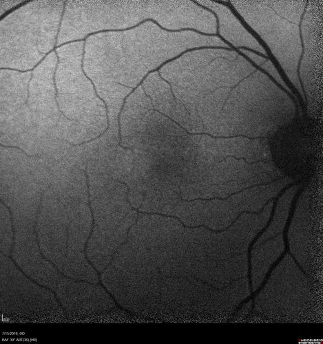 Macular Telangiectasia - Mild
56 year old female with good vision and mild macular telangiectasia.  VA 20/40 OD 20/16 OS
