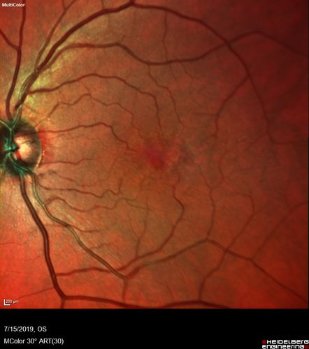 Macular Telangiectasia - Mild
56 year old female with good vision and mild macular telangiectasia.  VA 20/40 OD 20/16 OS
