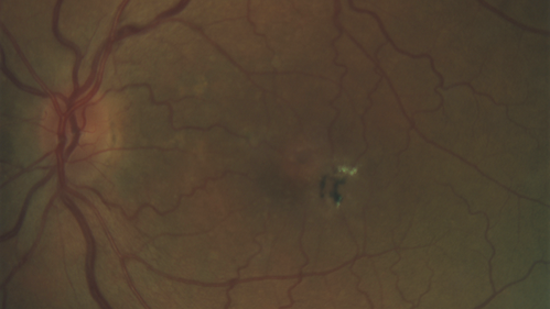 Stage V (neovascular) Macular Telangiectasia - Fluorescein
67 year old female with vision in only the left eye.  She has mild CNVM which is treated with Avastin and does well over several  years.
