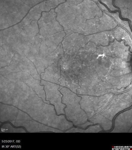 Stage V (neovascular) Macular Telangiectasia - Fluorescein
67 year old female with vision in only the left eye.  She has mild CNVM which is treated with Avastin and does well over several  years.
