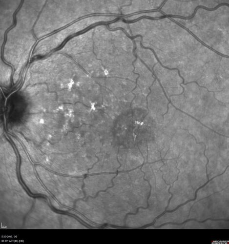 Stage V (neovascular) Macular Telangiectasia - Fluorescein
67 year old female with vision in only the left eye.  She has mild CNVM which is treated with Avastin and does well over several  years.
