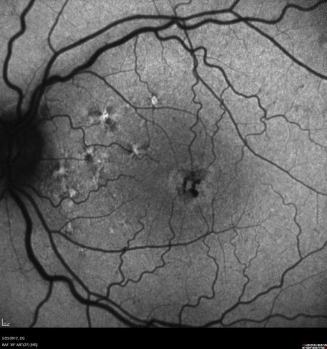 Stage V (neovascular) Macular Telangiectasia - Fluorescein
67 year old female with vision in only the left eye.  She has mild CNVM which is treated with Avastin and does well over several  years.
