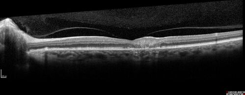 Stage V (neovascular) Macular Telangiectasia - Fluorescein
67 year old female with vision in only the left eye.  She has mild CNVM which is treated with Avastin and does well over several  years.
