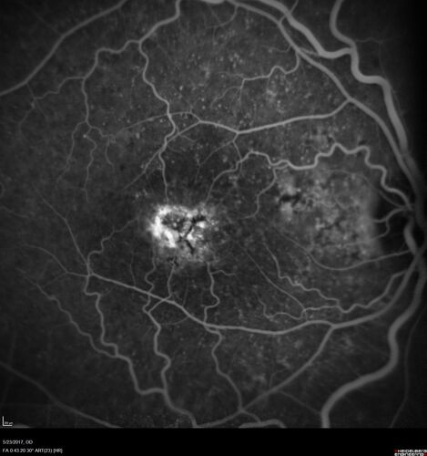 Stage V (neovascular) Macular Telangiectasia - Fluorescein
67 year old female with vision in only the left eye.  She has mild CNVM which is treated with Avastin and does well over several  years.
