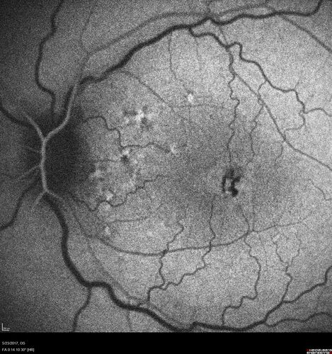 Stage V (neovascular) Macular Telangiectasia - Fluorescein
67 year old female with vision in only the left eye.  She has mild CNVM which is treated with Avastin and does well over several  years.

