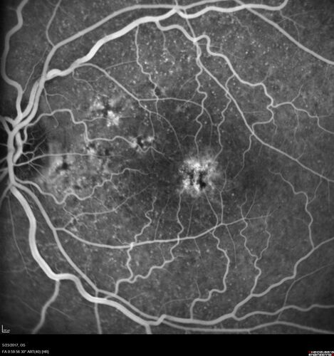 Stage V (neovascular) Macular Telangiectasia - Fluorescein
67 year old female with vision in only the left eye.  She has mild CNVM which is treated with Avastin and does well over several  years.

