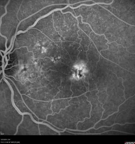 Stage V (neovascular) Macular Telangiectasia - Fluorescein
67 year old female with vision in only the left eye.  She has mild CNVM which is treated with Avastin and does well over several  years.
