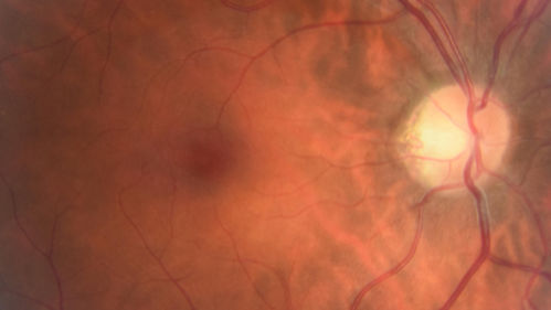 Macular Telangiectasis - Very Mild
52 year old female with normal vision and suspicious OCT referred.  Multimodal imaging shows very mild mactel (loss of macular pigment, ring on multicolor image and very mild OCT findings)
