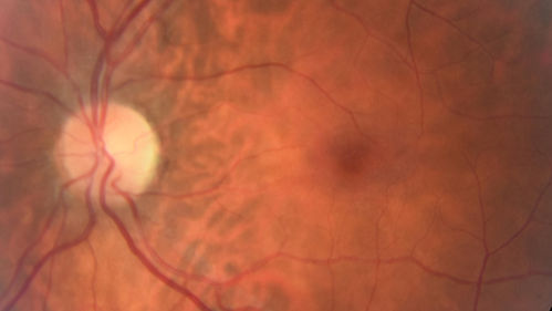 Macular Telangiectasis - Very Mild
52 year old female with normal vision and suspicious OCT referred.  Multimodal imaging shows very mild mactel (loss of macular pigment, ring on multicolor image and very mild OCT findings)
