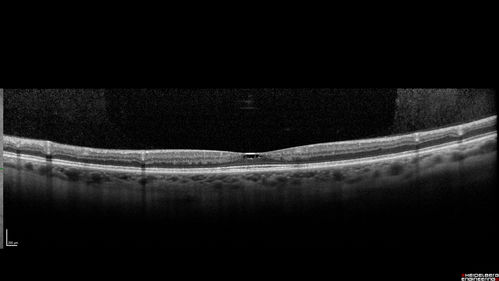 Macular Telangiectasis - Very Mild
52 year old female with normal vision and suspicious OCT referred.  Multimodal imaging shows very mild mactel (loss of macular pigment, ring on multicolor image and very mild OCT findings)
