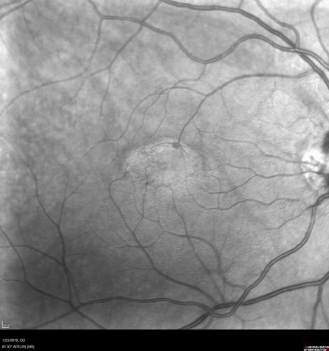 Macular Telangiectasis - Very Mild
52 year old female with normal vision and suspicious OCT referred.  Multimodal imaging shows very mild mactel (loss of macular pigment, ring on multicolor image and very mild OCT findings)
