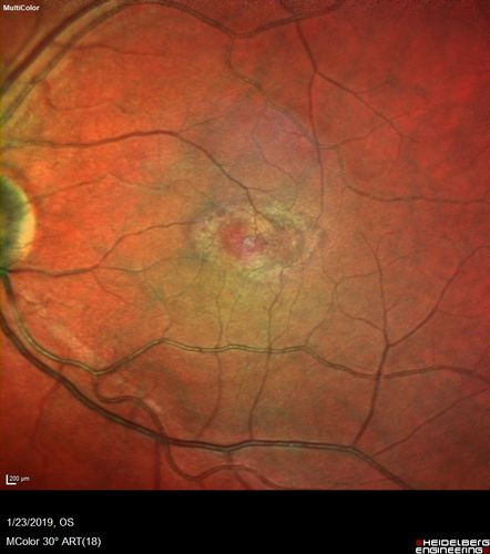Macular Telangiectasis - Very Mild
52 year old female with normal vision and suspicious OCT referred.  Multimodal imaging shows very mild mactel (loss of macular pigment, ring on multicolor image and very mild OCT findings)
