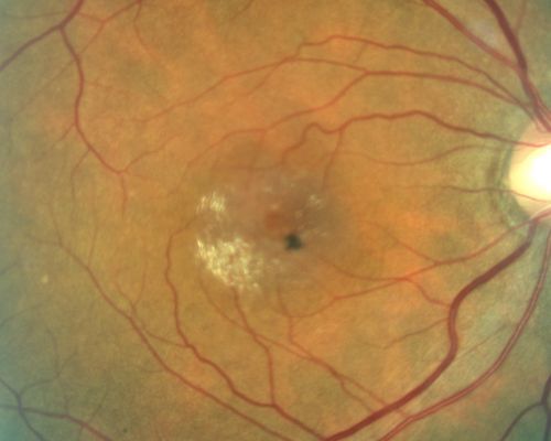 Juxtafoveal Telangiectasis and Newly Decreasing Vision
70-year-old woman followed for 10 years with IJFT with newly decreasing vision OU  OD:  20/160;  OD:  20/80
Keywords: mactel;juxtafoveal telangiectasis;telangectasia;crystals