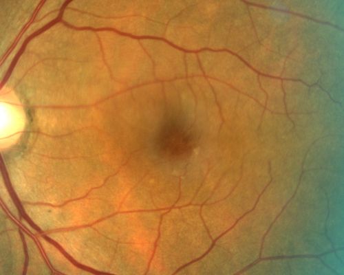 Juxtafoveal Telangiectasis and Newly Decreasing Vision
70-year-old woman followed for 10 years with IJFT with newly decreasing vision OU  OD:  20/160;  OD:  20/80
Keywords: mactel;juxtafoveal telangiectasis;telangectasia;crystals