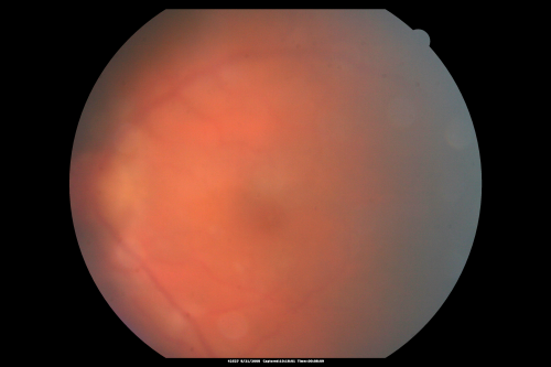 Fungal Endophthalmitis
65-year-old woman had chronic endophthalmitis in the left eye 1 day post-op vitrectomy.
Keywords: fungal endophthalmitis;retinitis;