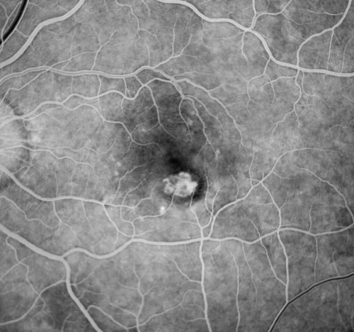 Wet AMD 62 year old male smoker 
62-year-old man has wet age-related macular degeneration in the right eye.  He has been undergoing treatment with Lucentis for that.  Then his left eye developed hazy vision a few weeks ago while he was overseas and now his vision is hazy in both eyes.   OD 20/40, OS 20/30.    FA shows a classic subfoveal choroidal neovascular membrane in the left eye, which is leaking and in the right eye, which is dry.
 He is going to stop smoking today.

Keywords: wet amd; smoker; avastin; bilateral