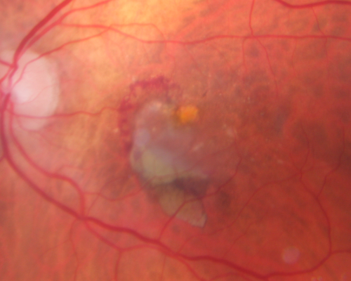AMD - Wet - Fibrovascular Hemorrhagic PED - Occult CNVM
87-year-old woman for one month OS:  20/60 Fibrovascular PED and Hemorrhage
Keywords: ped;fibrovascular;occult;hemorrhage;wet AMD