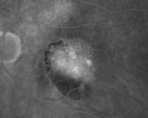 AMD - Wet - Fibrovascular Hemorrhagic PED - Occult CNVM
87-year-old woman for one month OS:  20/60 Fibrovascular PED and Hemorrhage
Keywords: ped;fibrovascular;occult;hemorrhage;wet AMD