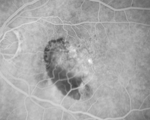 AMD - Wet - Fibrovascular Hemorrhagic PED - Occult CNVM
87-year-old woman for one month OS:  20/60 Fibrovascular PED and Hemorrhage
Keywords: ped;fibrovascular;occult;hemorrhage;wet AMD
