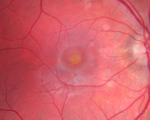 Multiple Evanescent White Dot Syndrome - Atypical Yellow Foveal Spot Right Eye
12-year-old had decreased vision in the left eye from reported amblyopia since around the year 2000.  His right eye was doing fine until  two days ago, when he had sudden severe vision loss.  He sees a blurred spot in the middle of the vision in the right eye wherever he looks. 
 OD 20/60 with eccentric movement, OS 20/200.   Pinhole 20/70.  IOP:  OD 14, OS 10.
Keywords: mewds;multiple evanescent white dot syndrome;yellow spot;vitelliform