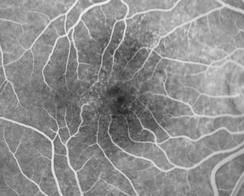 Idiopathic Cystoid Macular Edema - CME - Responded to Subtenons Kenalog - Early Fluorescein Showing Dilated Capillaries
49-year-old man had a flu two weeks ago the right eye has been throbbing and his vision in the right eye has been foggy.  OD 20/80, OS 20/40.   IOP:  14 OU.  

Schlüsselwörter: cme;cystoid macular edema;steroids;idiopathic