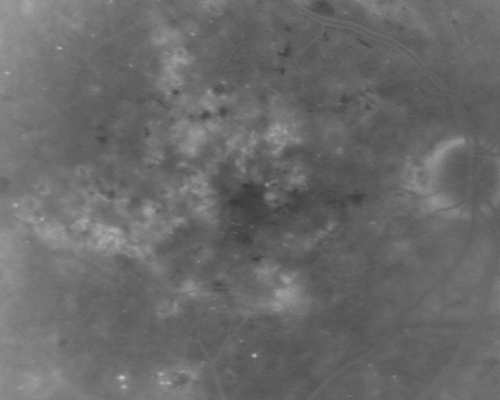 BDR and Diabetic Macular Edema with Fresh Laser Right Eye
60-year old man OD 20/60, OS 20/50 worsening vision both eyes
